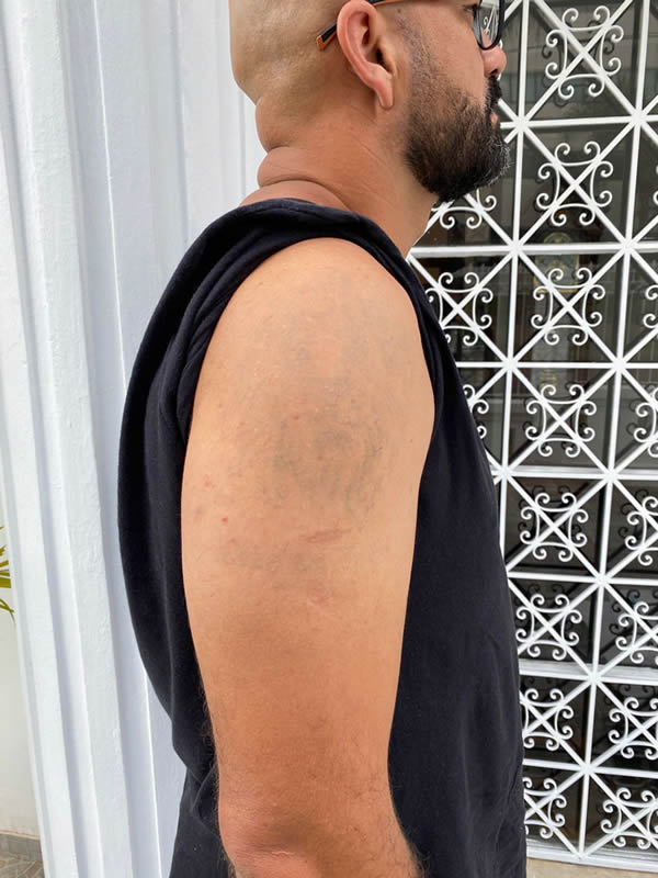 Remoção de tatuagem a laser em Curitiba